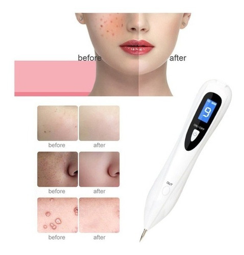 Plasma Pen Cauterizador 9 Niveles Quita Verrugas Pecas  