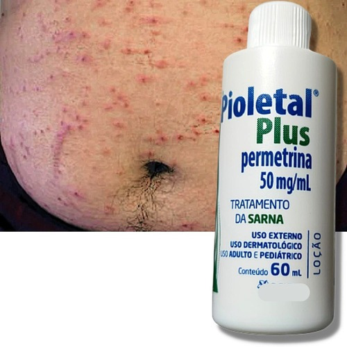 Coçeira Intensa No Corpo