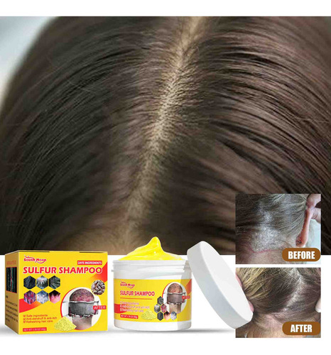 Shampoo M Enxofre Para Eliminar Piolhos, Aliviar Coceira E