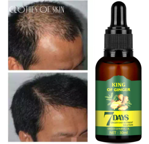Capilar Soro De Crescimento, 4pcs Óleo De Gengibre 30ml