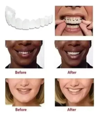 Sorriso Dentes Falsos Folheados W En La Parte Superior/infer