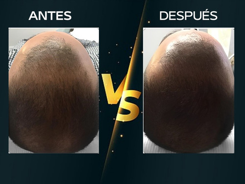 Loción Capilar Anticaída 100% Natural 130 Ml Caballero