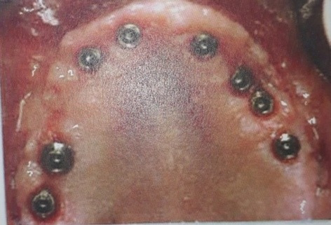 Imagen 2 de 5 de Implantes Dentales En 48 H