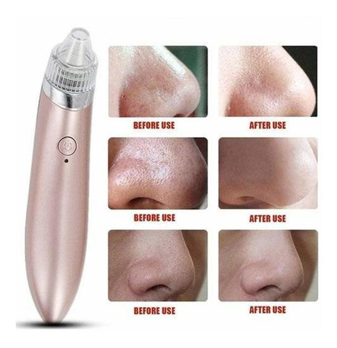 Exfoliante Extractor Removedor De Puntos Negros Grasa Acne
