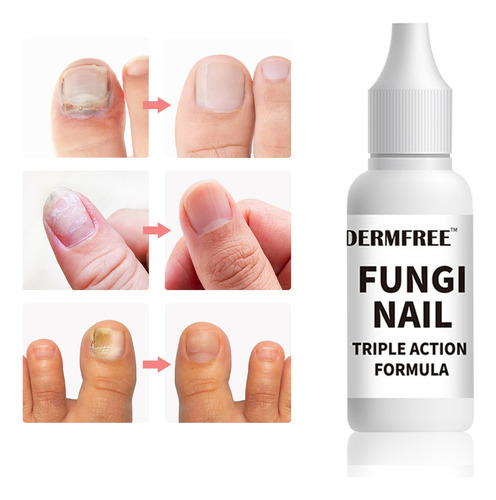 Hongo En Uñas Solución - Tratamiento De Uñas Grises 1pcs