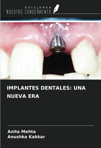 Libro: Implantes Dentales: Una Nueva Era (spanish Edition)