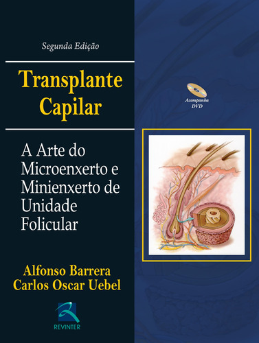 Transplante Capilar: A Arte do Microenxerto, de Barrera, Alfonso. Editora Thieme Revinter Publicações Ltda, capa dura em português, 2015