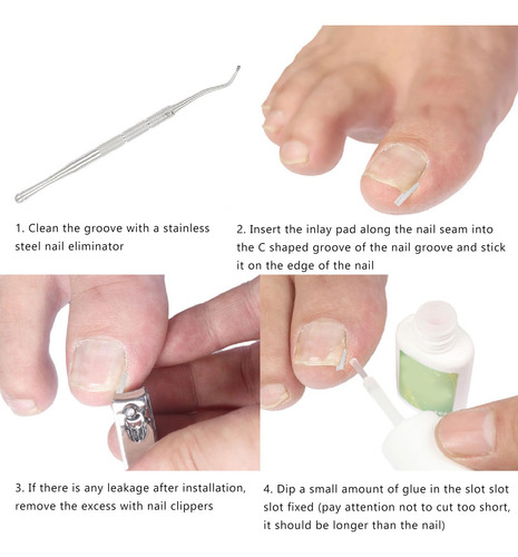 Kit De Eliminación De Uñas Encarnadas, 50 Pcs Corrector Con
