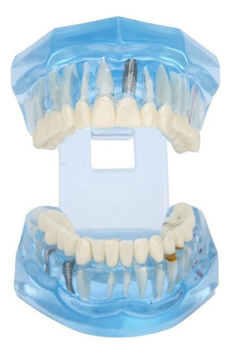 Youpin Dientes Dentales Modelo Acrílico Azul Transparente