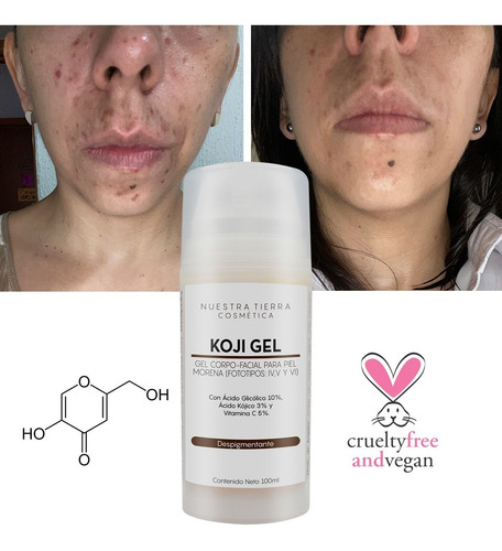Imagen 2 de 7 de Gel Despigmentante Para Piel Morena Con Ácido Kójico