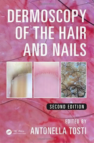 Dermoscopy Of The Hair And Nails, De Antonella Tosti. Editorial Apple Academic Press Inc. En Inglés