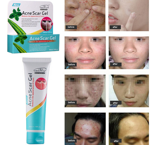 Q 35g Face Removal Cream Pimple Spots Scar Stretch Skin Care