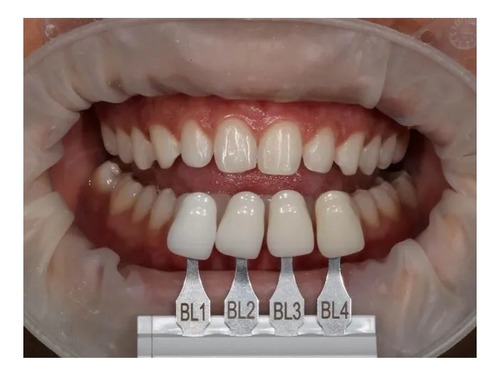 Resina Forma Con Zirconia Ultradent Dental Blancos Bl2