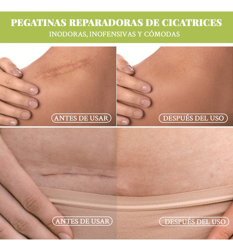 2pcs Silicona Scar Sheets Parche Para Eliminación Cicatrices