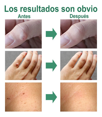 Tratamento E Remoção De Verrugas E Hpv