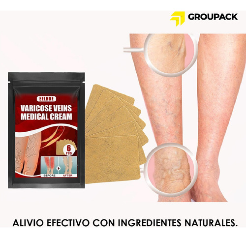 6 Parches Para Eliminar Las Venas Varicosas En Las Piernas