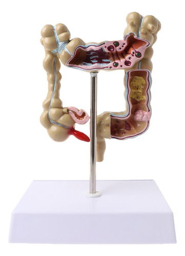 Para Para Modelo De Intestino Grueso Con Lesión De Colon