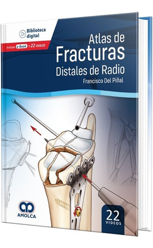 Atlas De Fracturas Distales De Radio. Edit. Amolca. E-book.