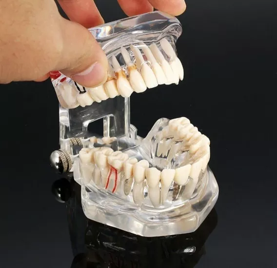 Modelo de implante demostrativo Naranja Anatomía patológica para escuelas de odontología Discusión del Tratamiento Yeelur Modelo Dental educación Dental 