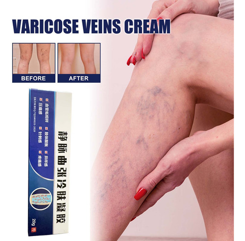 Venas Varicosas Para Piernas Crema Para Varices Varicose Vei