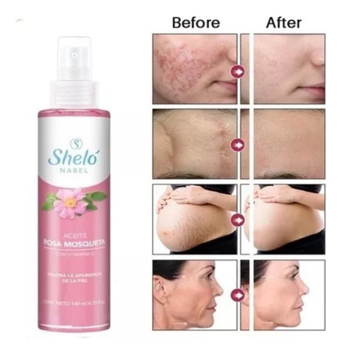 Crema Para Estrias Embarazo Previene Rosa Mosqueta Shelo Nab