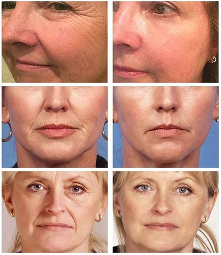 Retinol Antiarrugas