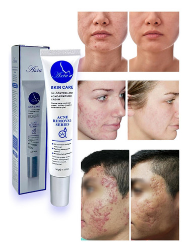Crema Anti Acné Elimina Granos Espinillas Tratamiento 30g Momento De Aplicación Noche Tipo De Piel Mixta