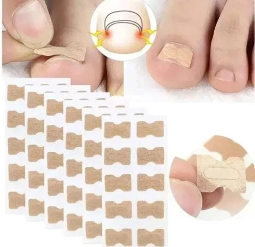 Parche Corrector De Uñas Encarnadas Pack X 10 Unidades