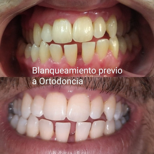 Imagen 5 de 5 de Dentista-odontólogo/limpieza De Sarro