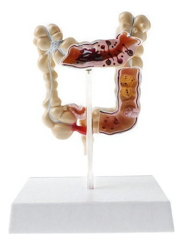 Modelo de estudio de patología del intestino grueso humano 1:2 Cor Fix