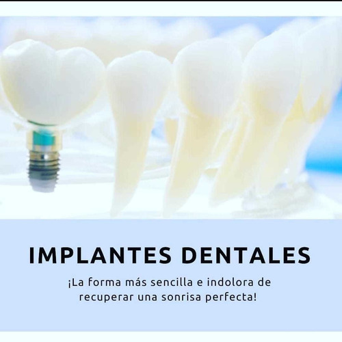 Imagen 1 de 9 de Implantes Dentales. Montevideo, Colonia, San Jacinto