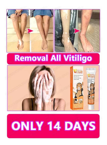 Crema Tratamiento Profesional Para Eliminar El Vitiligo Original