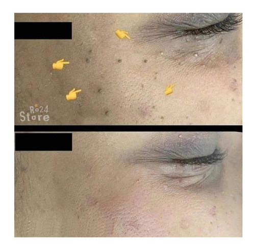 Imagen 10 de 10 de 2 Unid Elimina Verruga Papiloma Lunar Rostro Cuerpo Genital