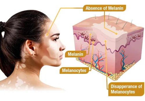 J Crema Para El Tratamiento Del Vitiligo De Veneno De Abeja