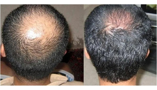 Cabello Mas Fuerte Y Mas Abundante, Mxshw-004, 5 Pza, 250ml