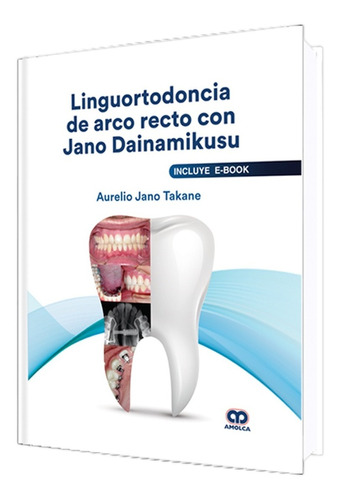 Linguortodoncia De Arco Recto Con Jano Dainamikusu