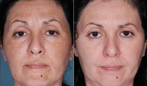 Serum Ac. Hialuronico E Retinol Clareador Manchas