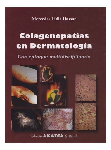Colagenopatias En Dermatologia (multidisciplinario) Hassan 