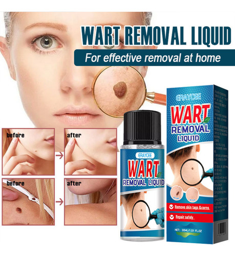 30ml Tira Verruga Sem Dor Crianca Ou Adulto Em Uma Semana