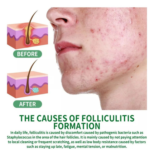 Ha Crema For Dermatitis Seborreica, Psoriasis Y Foliculitis.