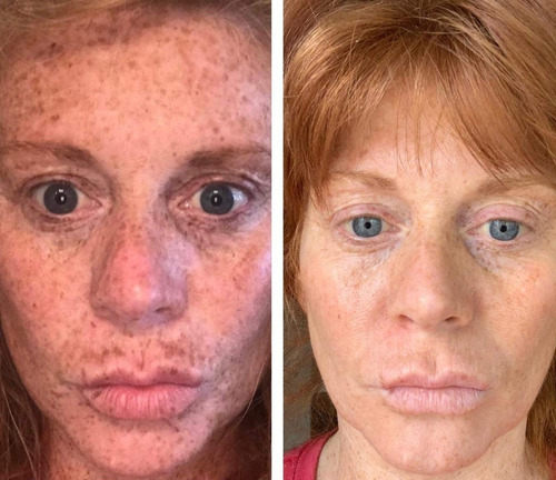 Admire My Skin 2 % Hydroquinone Remove - mL a $5000
