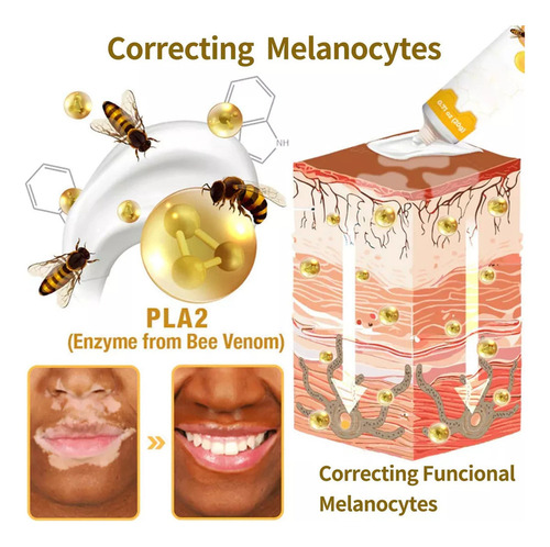 Crema For El Tratamiento Del Vitiligo De Bee De Abeja