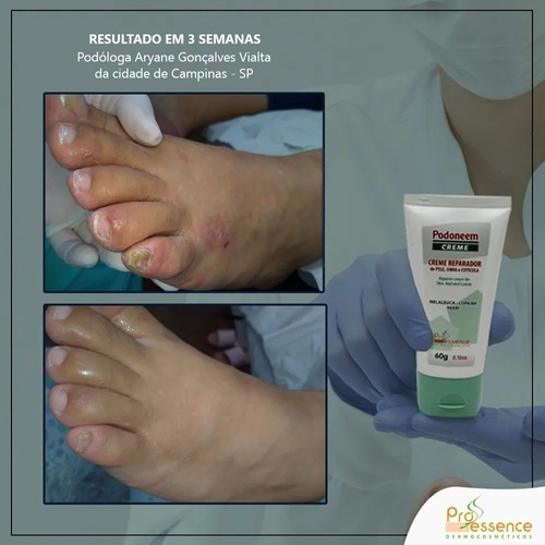 Creme Para Frieira - Com Melaleuca, Copaíba E Neem 60g