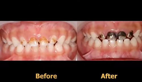 Imagen 4 de 7 de Fagamín Fluoruro Diamino Plata Dental 5ml Santiago