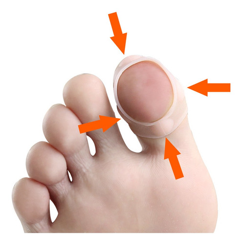 5 Pares De Corrector De Uñas Encarnadas De Silicona, Fundas