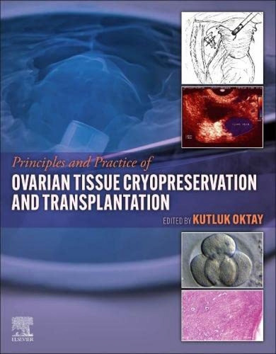 Principles And Practice Of Ovarian Tissue Cryopreservation A
