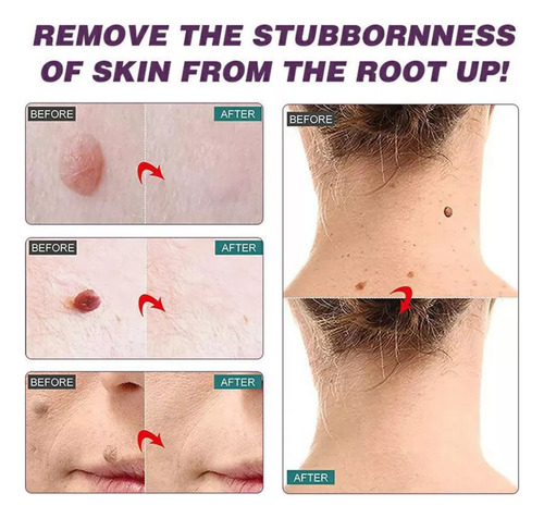 Crema Removedora De Verrugas Skin Para Eliminar Lun