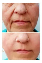 Comprar  Ácido Hialurónico Al 15% Anti-age + Dermaroller +24 Hilos 