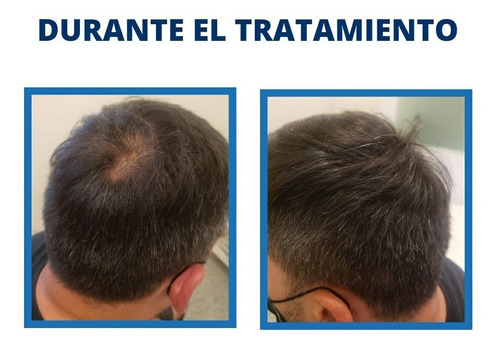 Imagen 5 de 5 de Mesoterapia Capilar