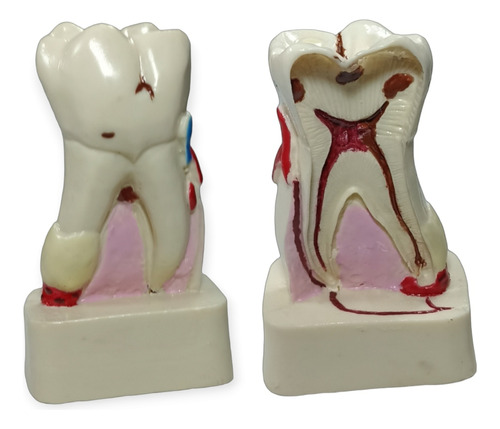 Modelo Dental Carie En Molar Dentista Dental Clinica